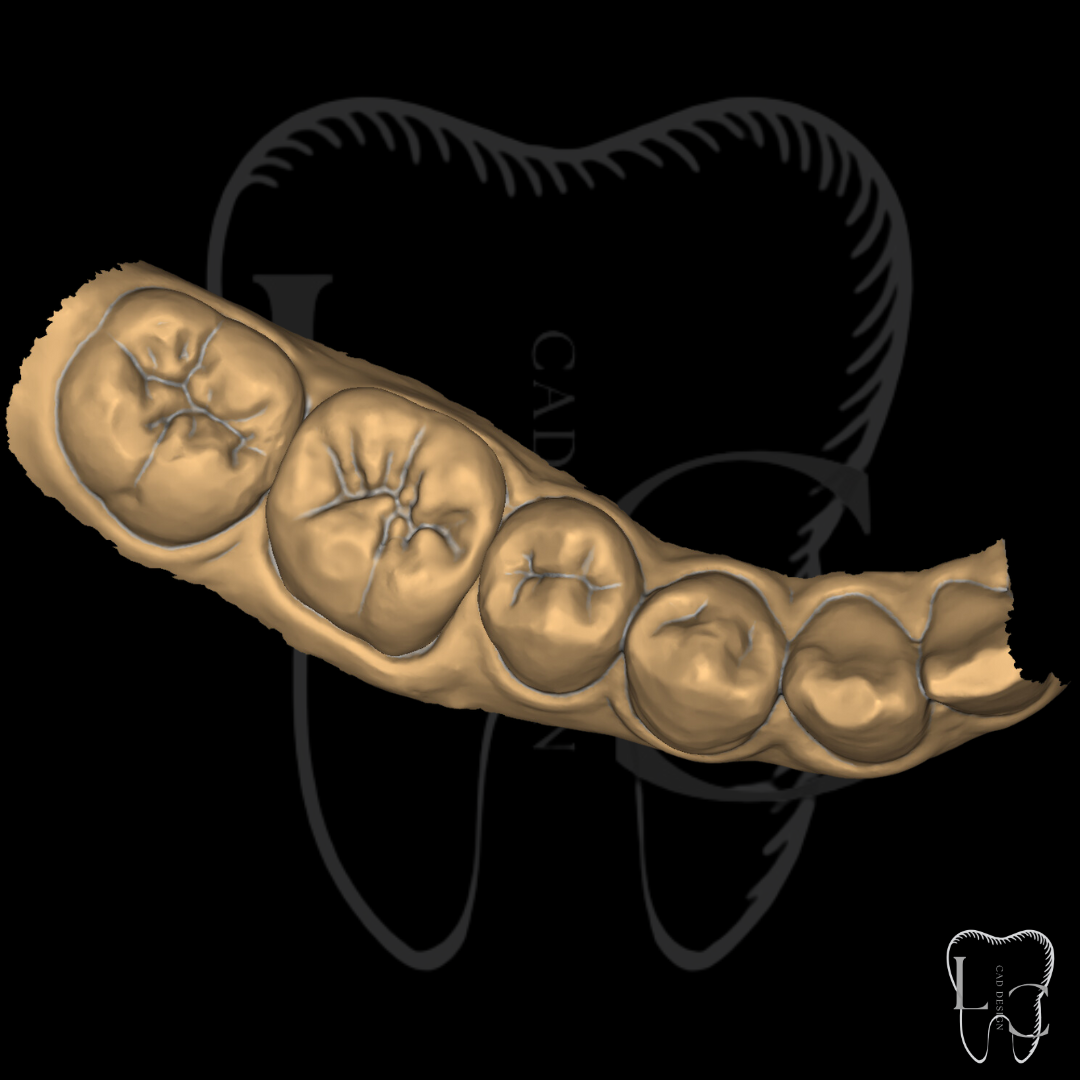 Coroa unitária no Exocad