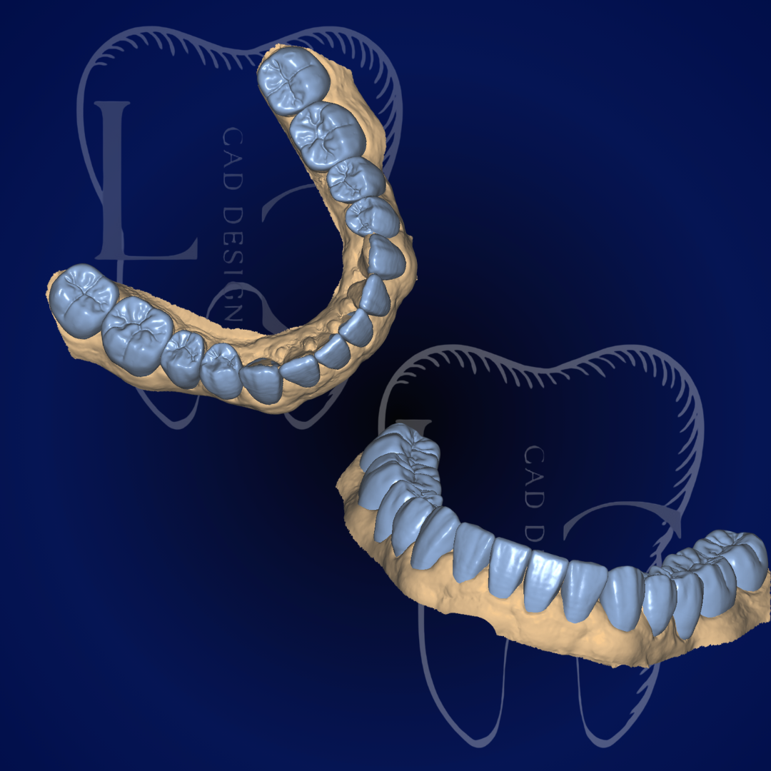 Facetas e coroas no Exocad