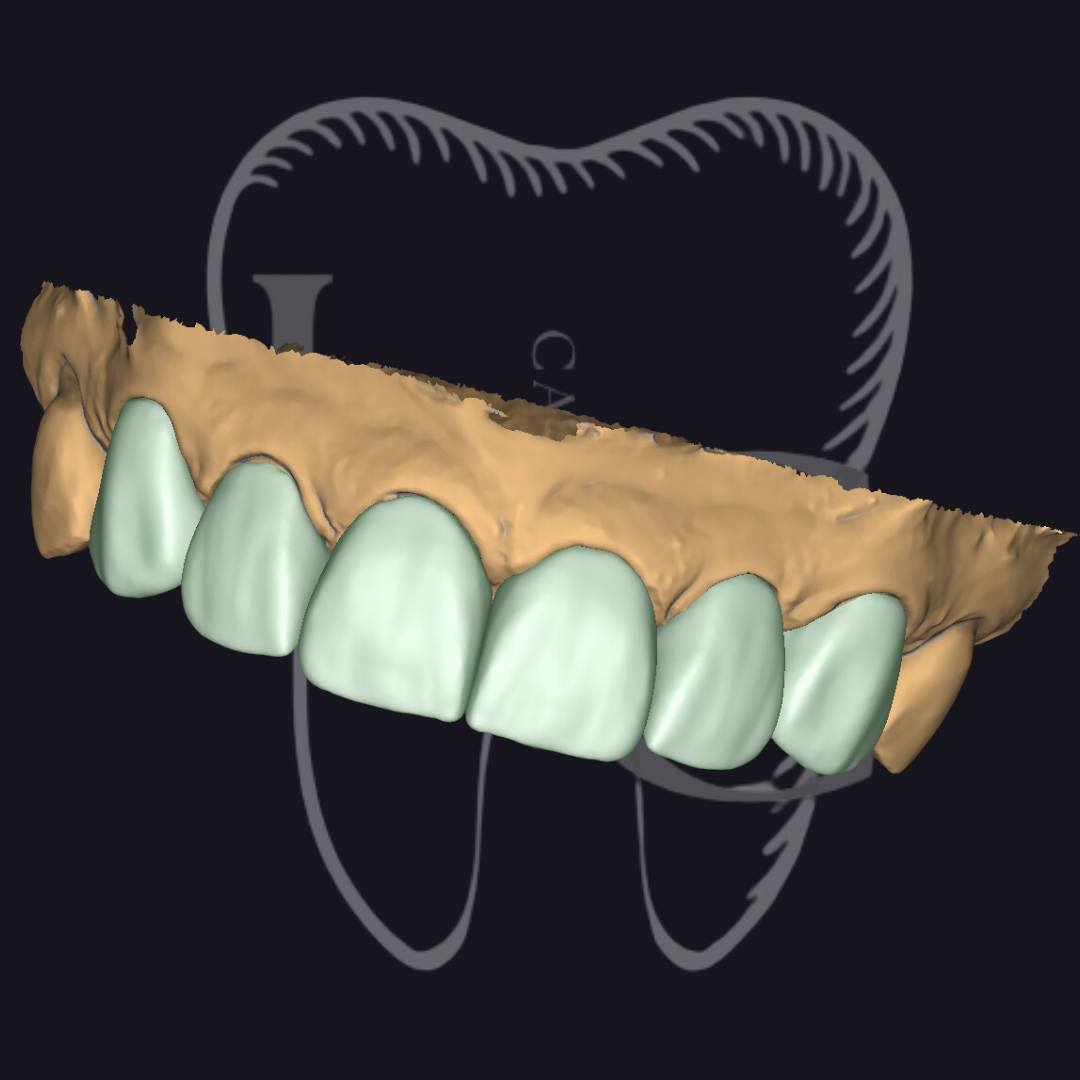 Facetas anteriores no Exocad