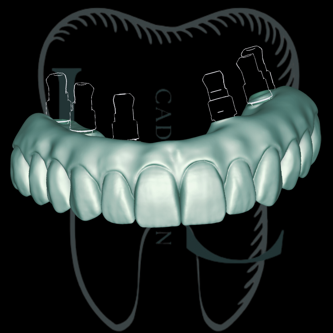 Protocolo implantossuportado no Exocad