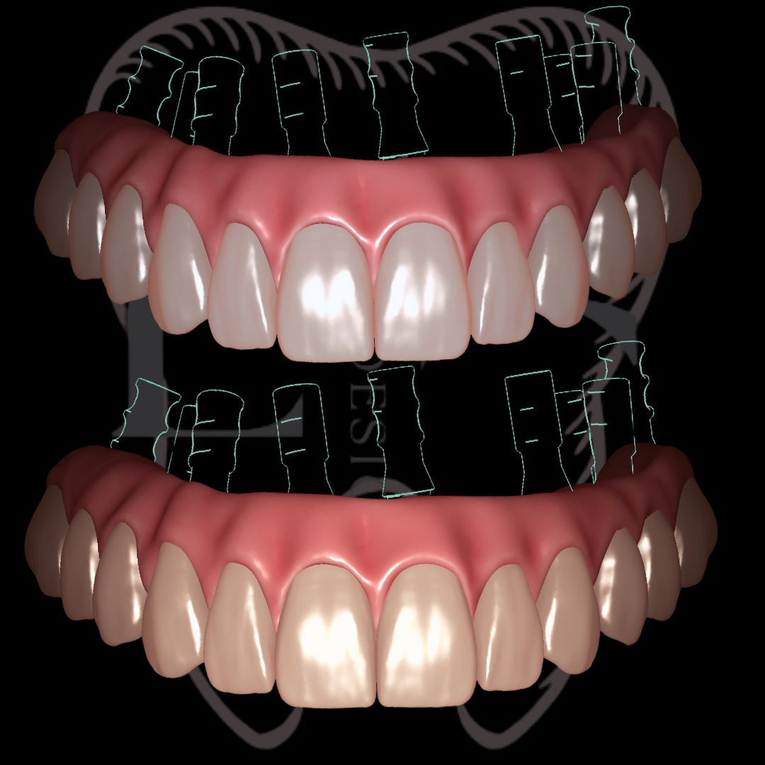 Protocolo full arch superior no Exocad